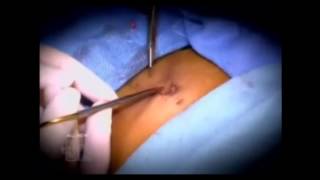 Umbilicoplasty Corrects Belly Button Bulges And Irregularities | Pittsburgh Umbilicoplasty Corrects Belly Button Bulges And Irregularities | Pittsburgh
