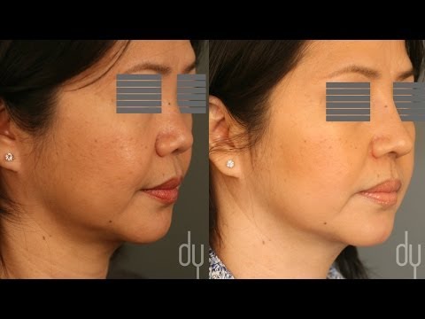 Asian Rhinoplasty | Before & After | Diced Cartilage Fascia (DCF) - Beverly Hills
