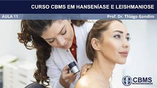 CURSO CBMS EM HANSENÍASE E LEISHMANIOSE AULA 11