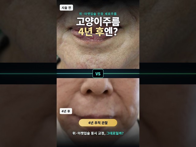 인중세로주름 "효과 얼마나 가요?" 4년 추적한 결과#연세자연미 #shorts #위아랫입술주름동시교정 #입술주름관리