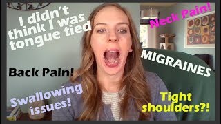 All About My Adult Tongue Tie Release - Frenuloplasty - Frenectomy