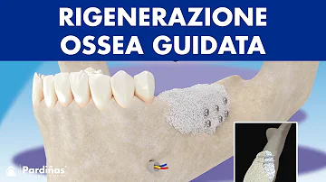 Come avviene la rigenerazione ossea dentale?