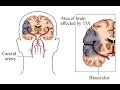 Transient Ischemic Attack (TIA)