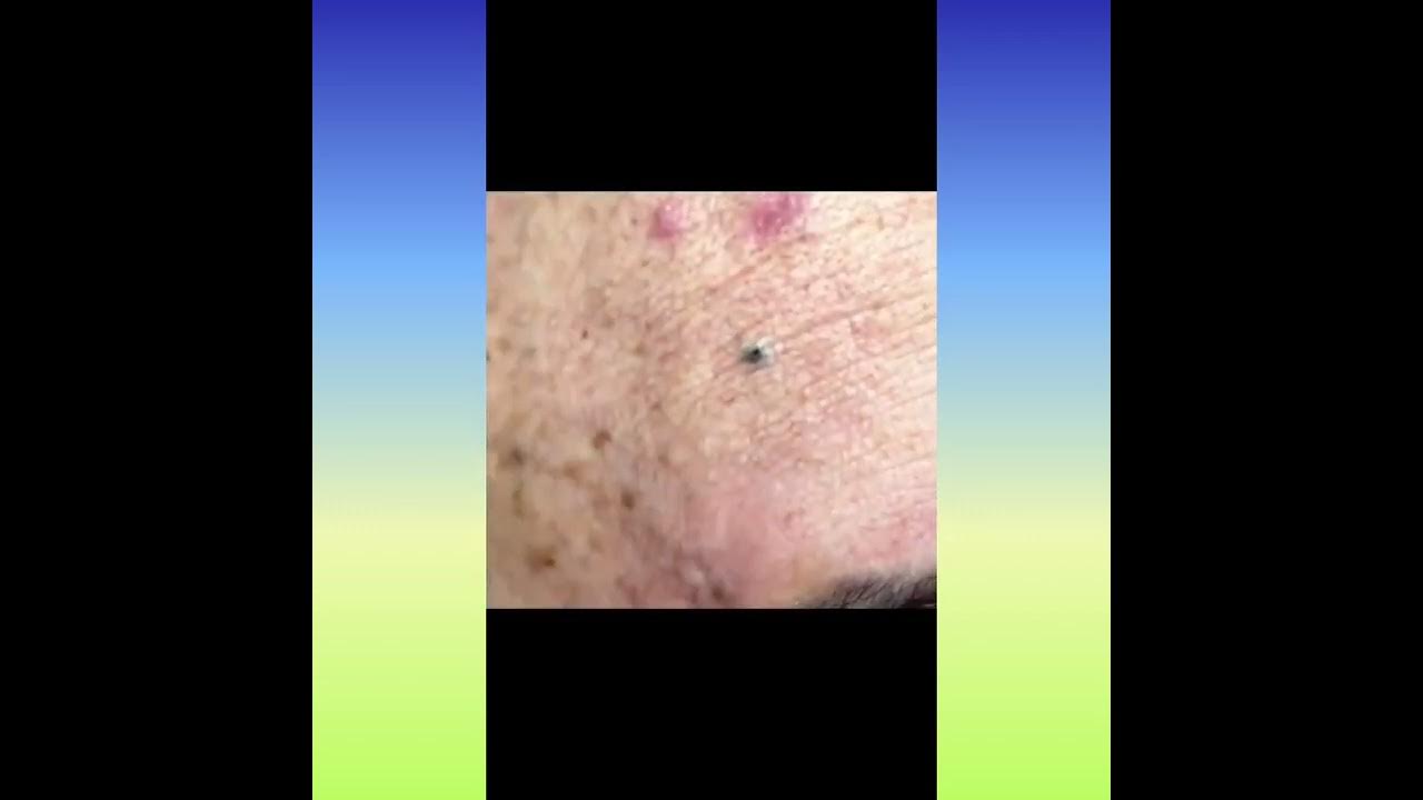 oddly satisfying video 22, blackhead removal zits button popping
