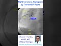 Right coronary angiogram by trans radial route