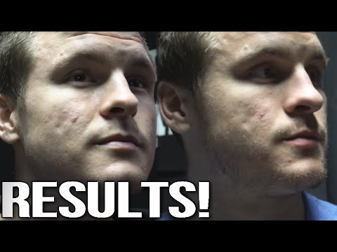 Results of My First DermaPen Treatment! | Acne Scar Comparison