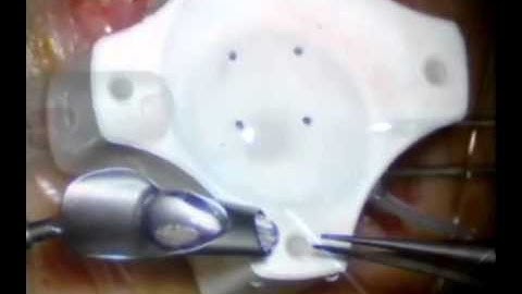 Modified Technique for DSAEK Graft Delivery