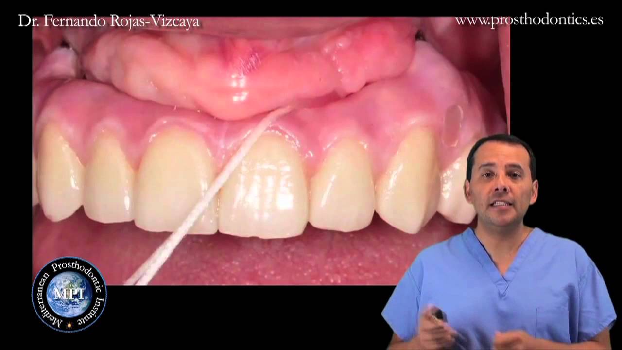 ¿Cómo limpiar los implantes dentales?