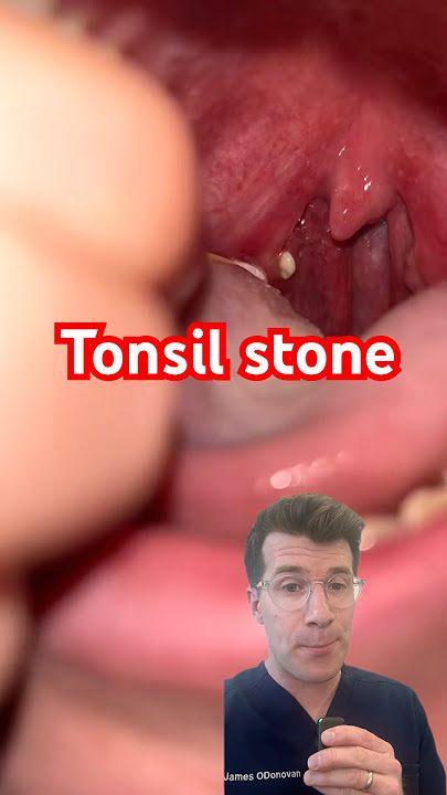 Doctor explains Tonsil Stones #shorts