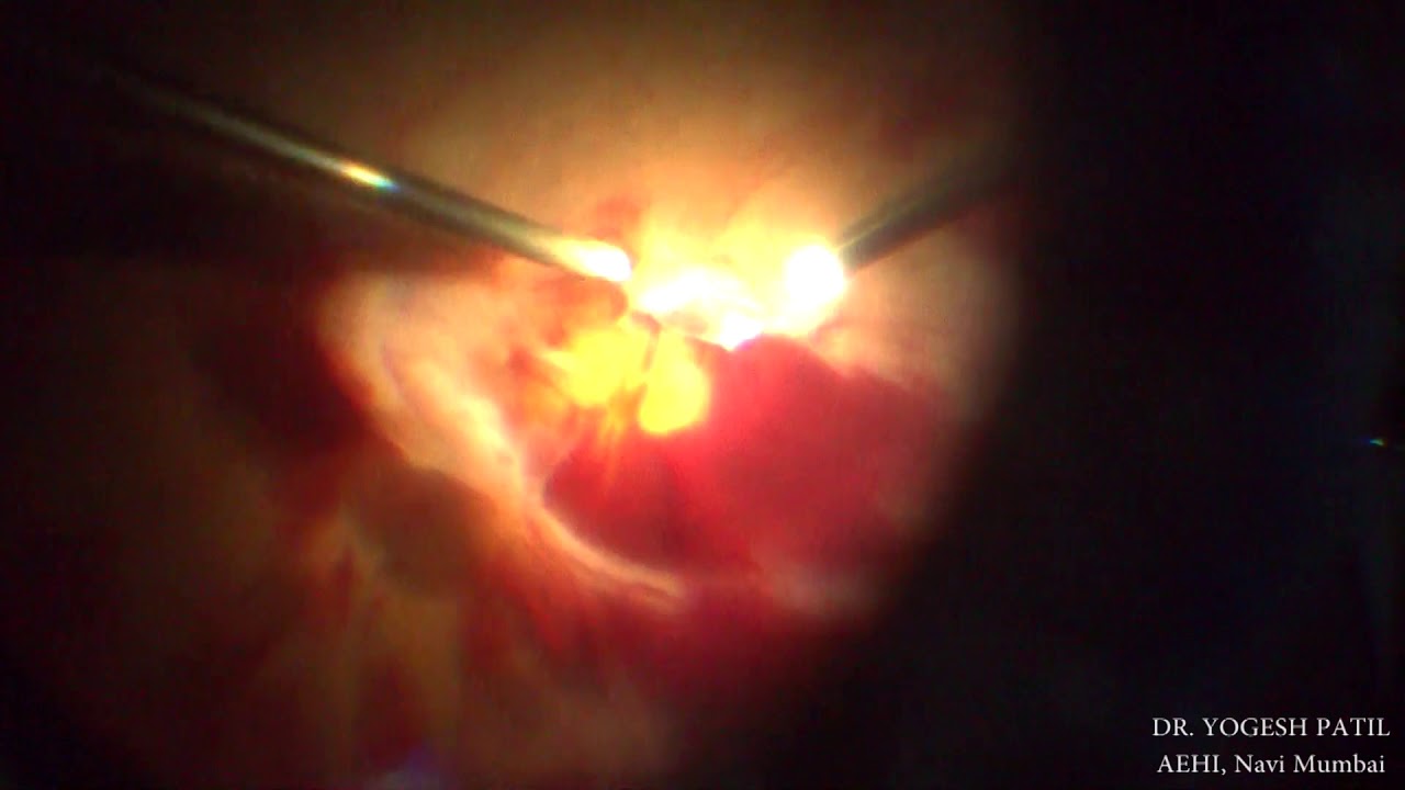Diabetic Retinopathy Treatment-Vitrectomy Surgery by Dr. Yogesh Patil, AEHI, Navi Mumbai