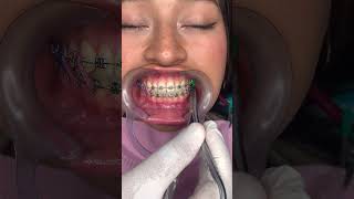 🔥Fuerzas con Elásticos en los Brackets🔥