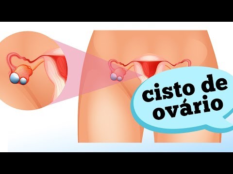 COMO IDENTIFICAR UM CISTO DE OVÁRIO?