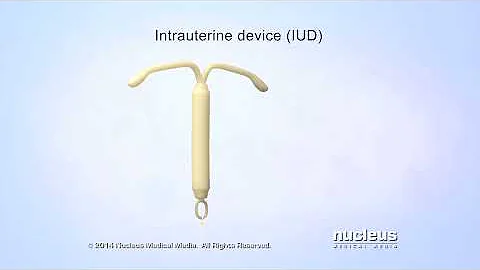 What is an IUD?