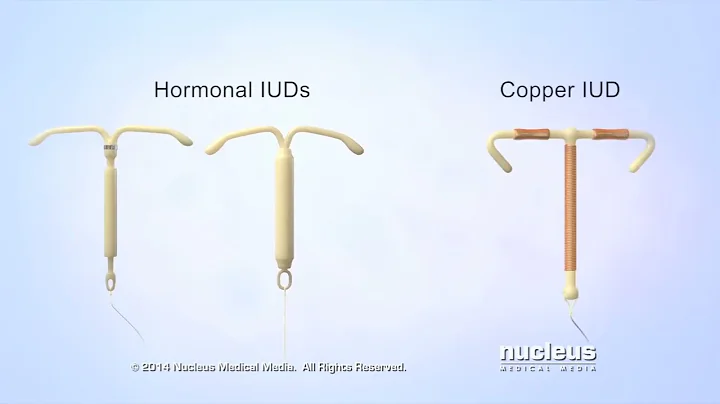 What is an IUD?