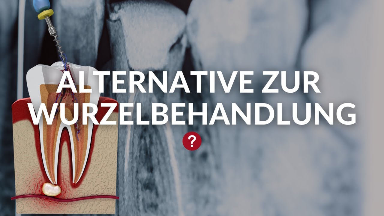 Gibt es Alternativen zur Wurzelbehandlung? | Wurzelbehandlung | Dr. Anne Karl