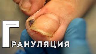 Образование грануляционной ткани вокруг вросшего ногтя #подологтатьянапак