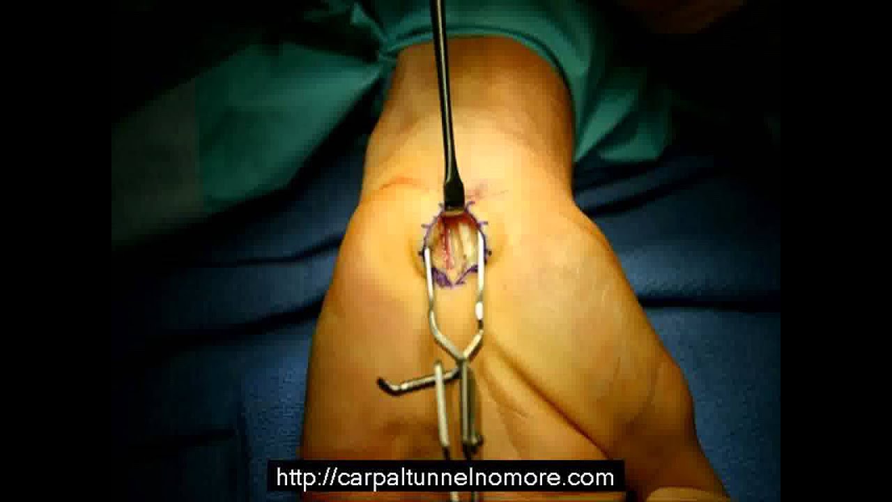 carpal tunnel syndrome test carpal tunnel syndrome test