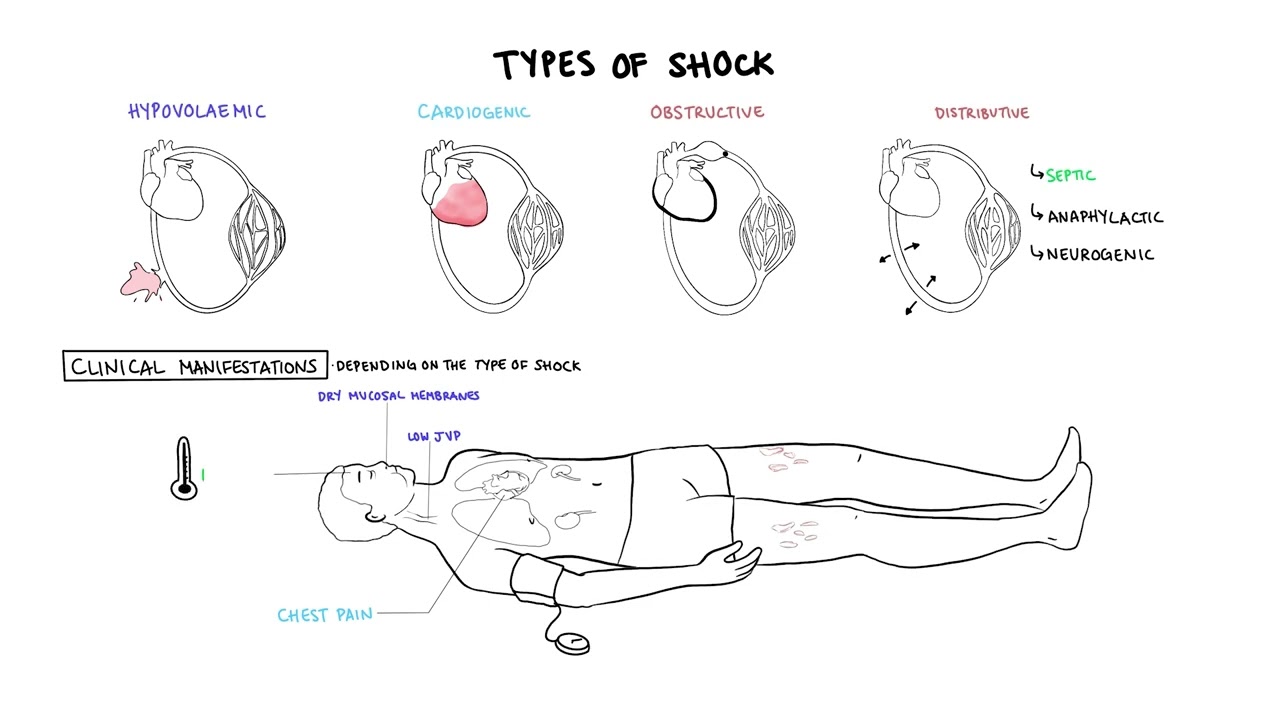 ⁣Approach to Shock - types, hypovolemic, cardiogenic, distributive, anaphylaxis, pathology, treatment