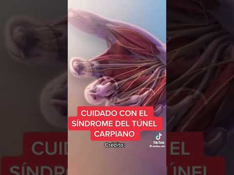 Video: Cómo prevenir el síndrome del túnel carpiano (con imágenes)