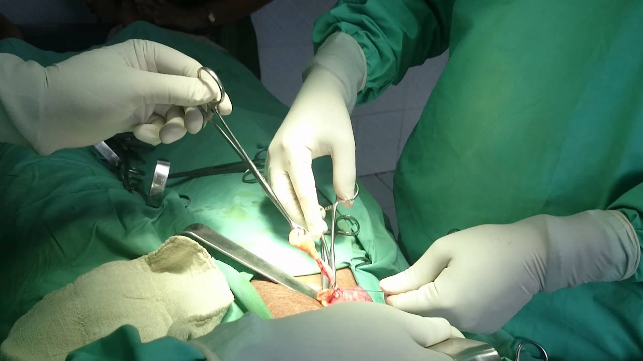 Appendectomy Surgery Youtube