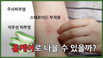 주사피부염, 스테로이드부작용,아토피,지루성피부염은 보습, 홈케어로 나을수 있을까? #40