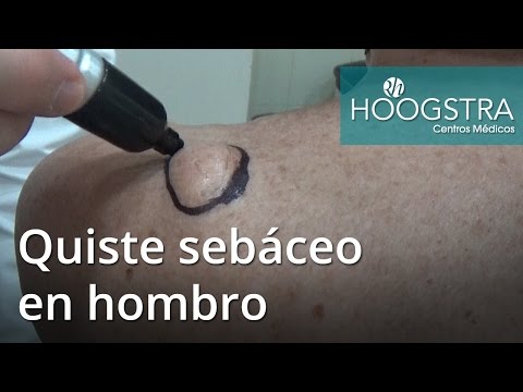 protuberancia en el hombro protuberancia en el hombro