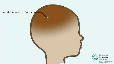 Correctie voorhoofd bij scheve schedel of plagiocephalie