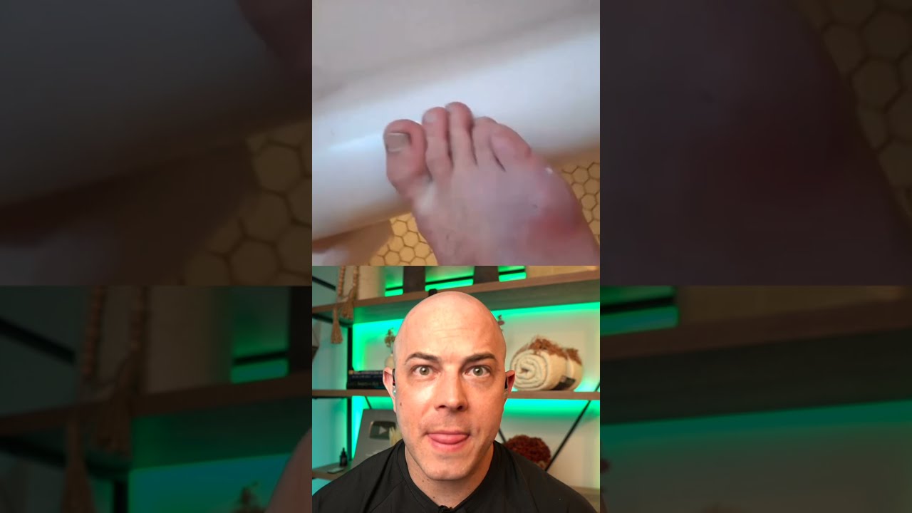 Dermatologist Reacts To Big Infected Splinter Removal Dermreacts Doctorreacts