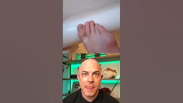 Thumbnail of Dermatologist reacts to big infected splinter removal! #dermreacts #doctorreacts #splinter