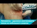 Липоматоз - удаление конгломерата липом из одного небольшого разреза