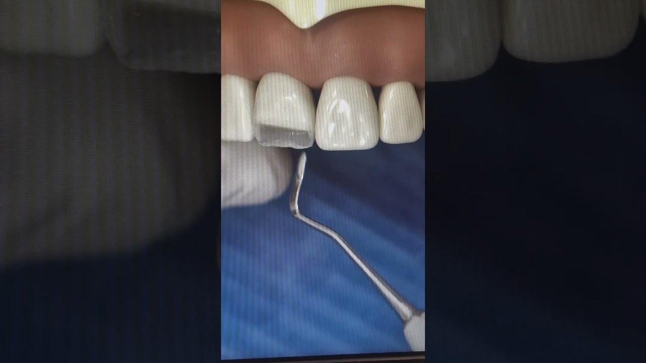 ANTERIORI PAOLONE 3.2