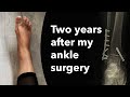 Two years after my ankle surgery  trimalleolar ankle fracture