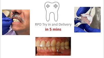 RPD Wax try & Delivery in 5 mins