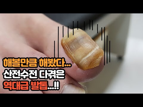 해볼만큼 해봤다... 산전수전 다겪은 역대급발톱의 변화! Most satisfying fungal toenail