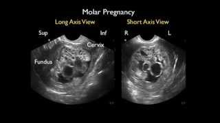 Ultrasound Detection of a Molar Pregnancy in the Emergency Department