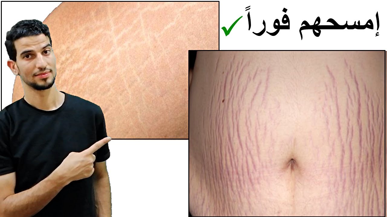 وداعا علامات التمدد والخطوط الحمراء والبيضاء  stretch marks