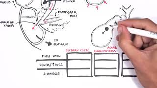 Acute Cholecystitis - Kaplan Medical gives an overview signs and symptoms, pathophysiology