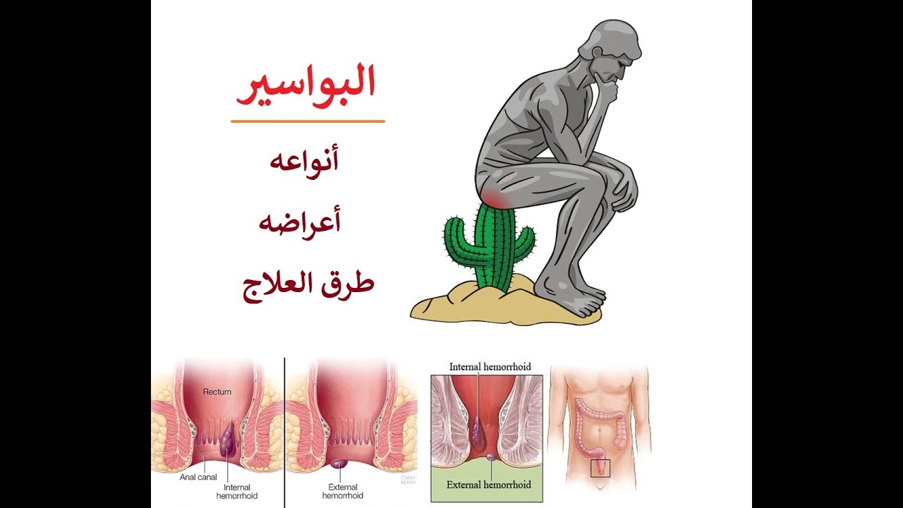 كيفية تشخيص البواسير, علامات البواسير, طرق علاج البواسير, طرق علاج البواسير...