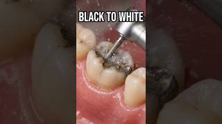 BLACK to WHITE Magic! Old Amalgam Filling Replaced - Satisfying Dental Restoration 🤯 #dentist  #asmr