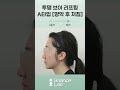 투명브이리프팅 A타입 [양악 후 처짐] 1달차😄 #shorts #실리프팅 #실리프팅후기 #실리프팅전후  #리프팅 #투명브이리프팅 #라포엘 #밸런스랩성형외과