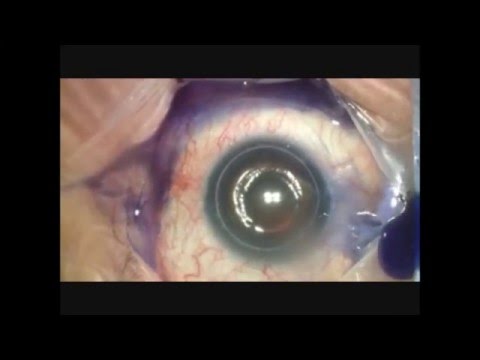 Haptic damage,IOL Exchange 2.2mm. Clear Corneal   incision.  Grigor Kamushadze MD.გრიგოლ ქამუშაძე
