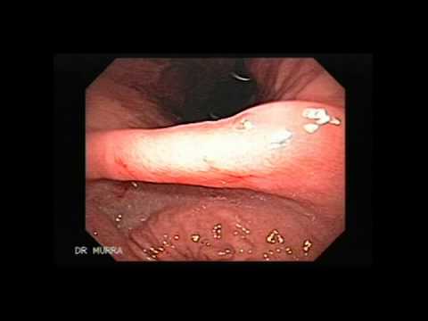 Upper endoscopy: Guide for children. Upper endoscopy: Guide for children.
