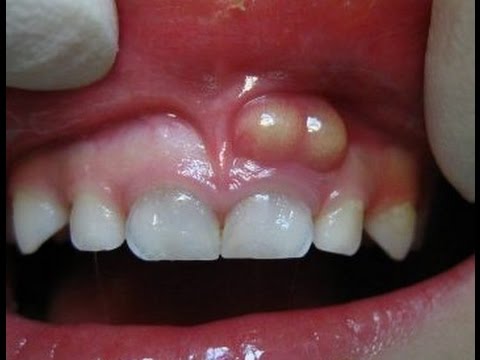 Vídeo: Remédios Caseiros Para O Dente De Abscesso: 10 Remédios Para Inchaço E Dor