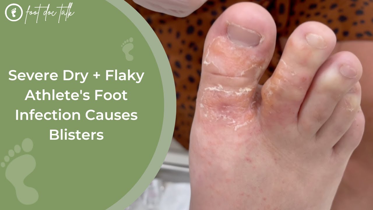 Severe Dry Flaky Athletes Foot Infection Causes Blisters Youtube
