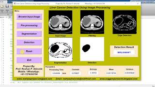 LIVER CANCER DETECTION Using Image Processing Matlab Project Source Code