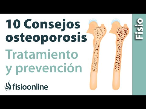 10 consejos para el tratamiento y prevención de la osteoporosis o pérdida de hueso