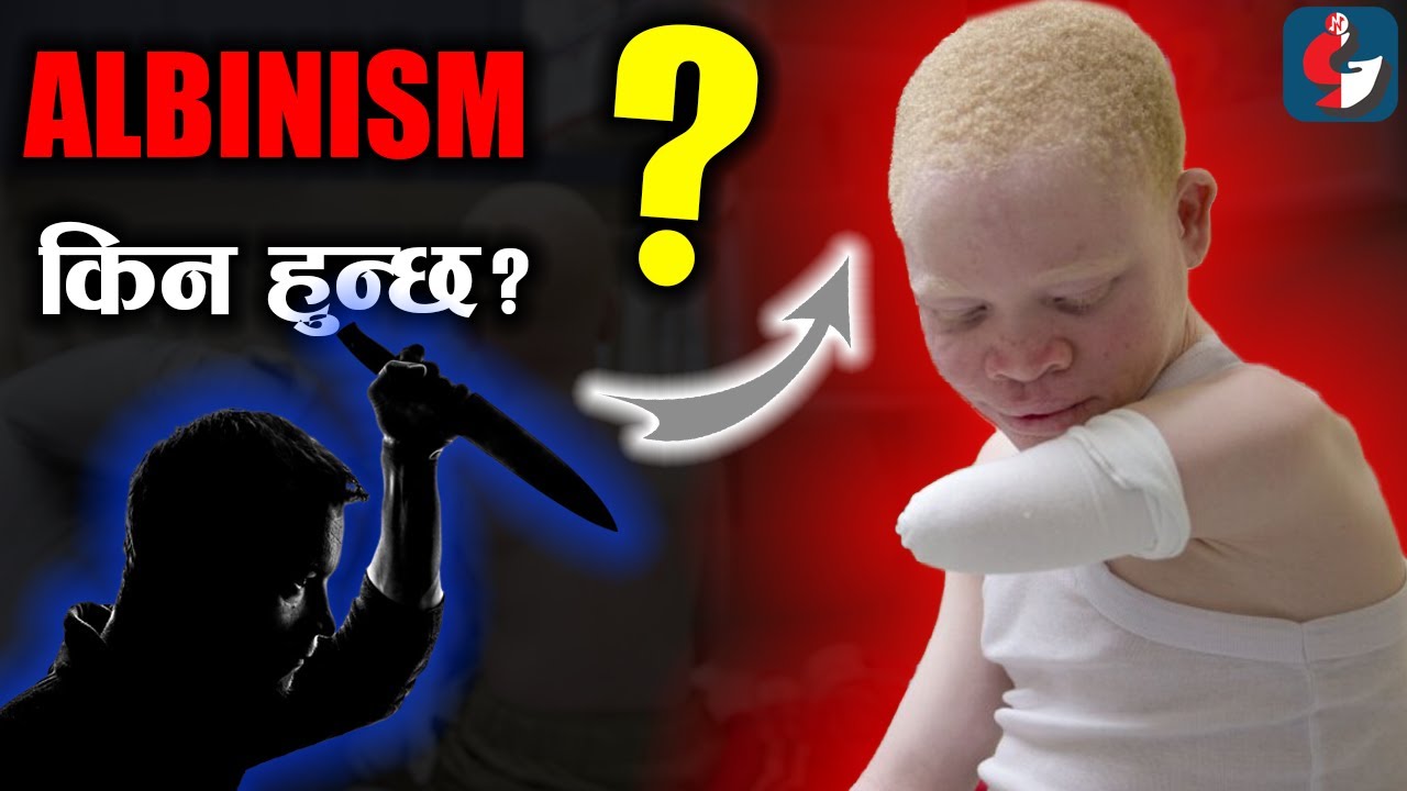 एल ब न बच च क न जन म न छ Why Albino Human And Animal Born Gonisa Albinismnepali Youtube