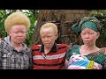 Born Too White: What It's Like To Have Albinism in Africa | BORN DIFFERENT