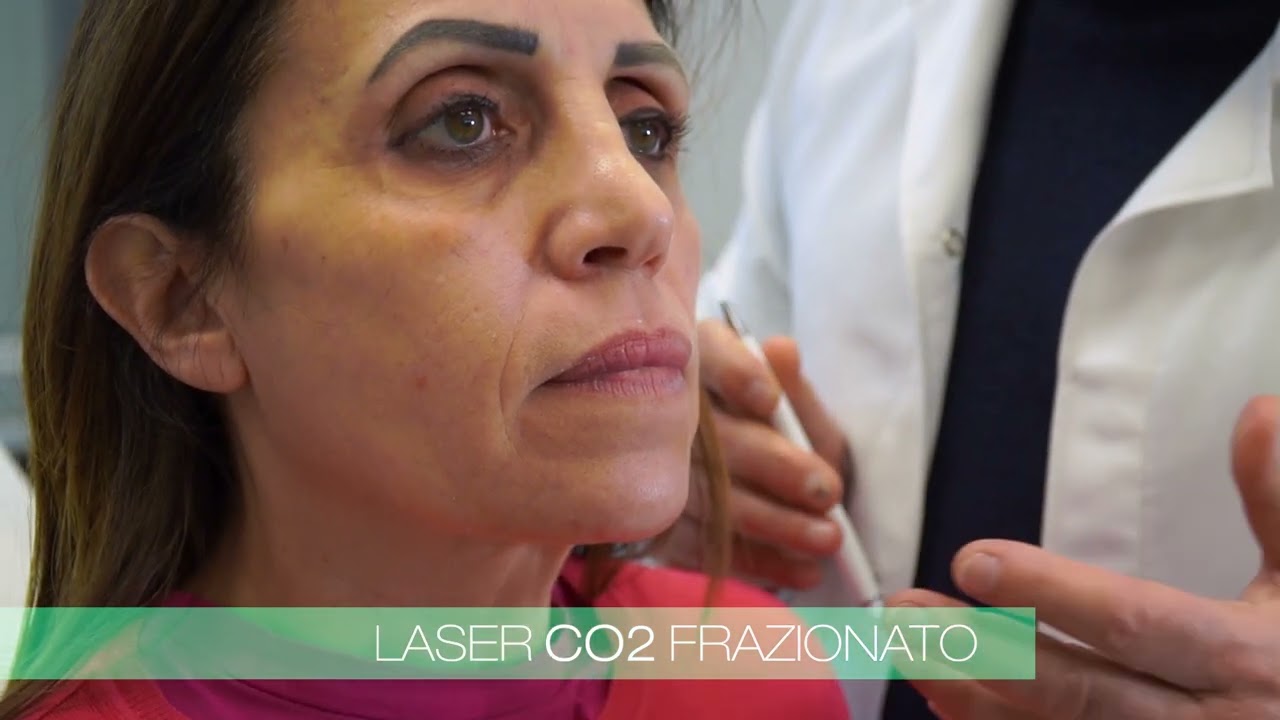 Laser CO2 Frazionato Napoli - Ringiovanimento Cutaneo Napoli - laser frazionato non ablativo Ydun