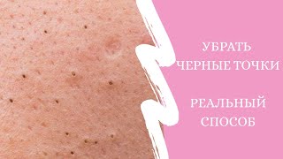 УБРАТЬ ЧЕРНЫЕ ТОЧКИ . Реальный способ. Без косметологов и масок. Кожа после РОА